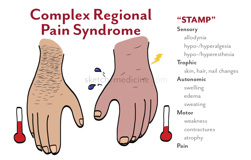مطالعه درمان سندروم درد ناحیه ای پیچیده به کمک سلول های بنیادی توسط کلینیک کلیولند